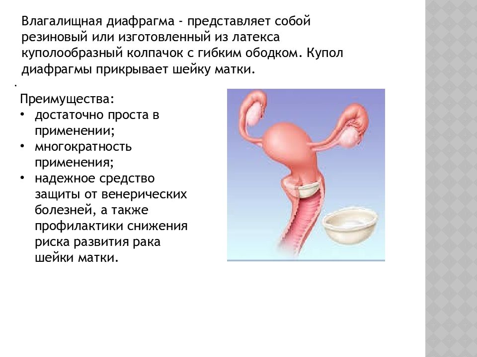 Барьерная функция органов. Барьерные методы контрацепции. Физиологический метод контрацепции. Диафрагма (контрацепция). Физиологический метод контрацепции плюсы и минусы.