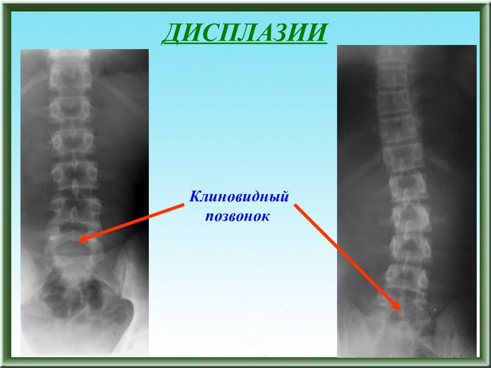 Клиновидные позвонки. Деформация позвонков рентген. Клиновидная деформация позвонка. Клиновидная деформация тела позвонка. Клиновидная деформация позвонков рентген.