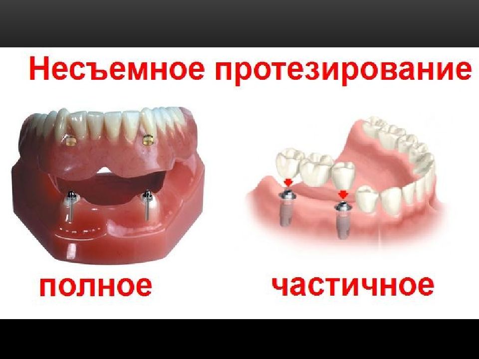 Осложнения при применении зубных протезов презентация