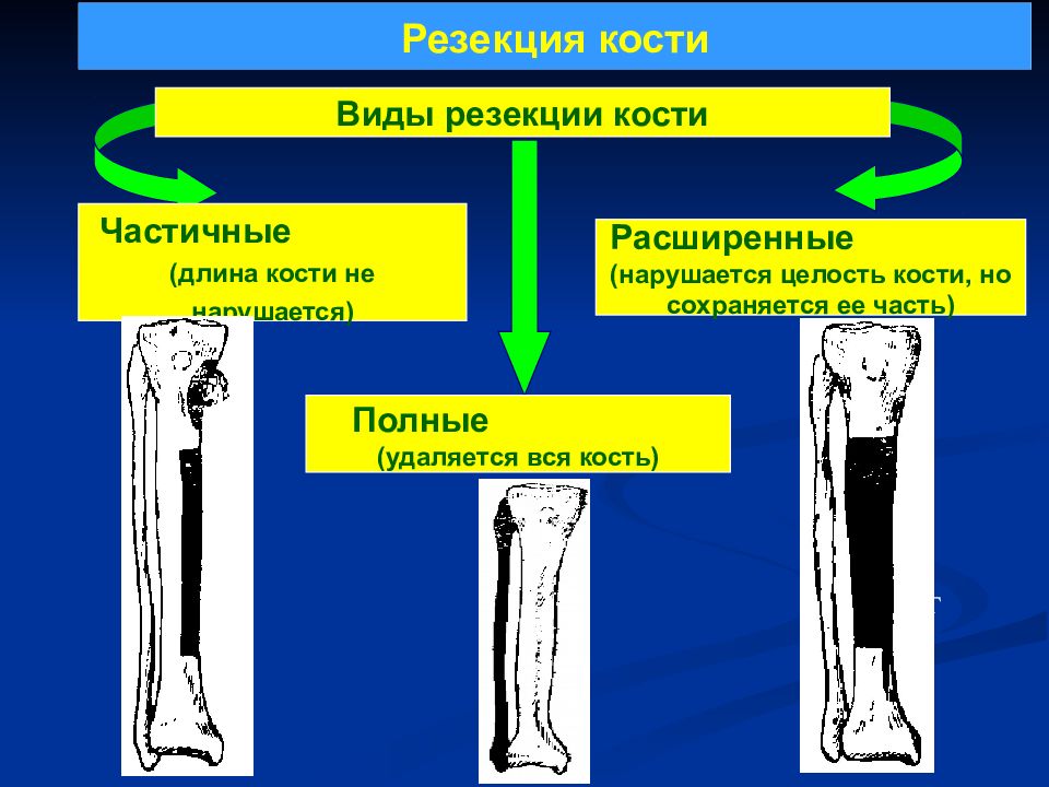 Стать на костях. Виды операций на костях. Краевая резекция плечевой кости. Сегментарная резекция длинной кости.