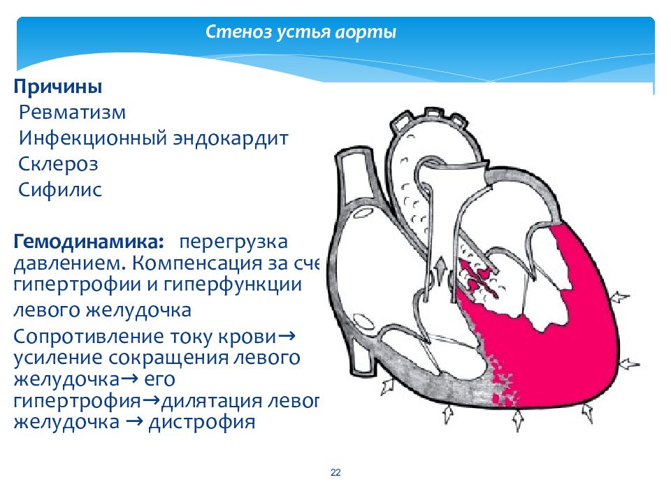 Схема гемодинамики при пороках сердца