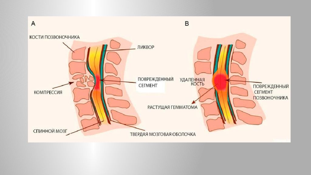 Лечение защемления нерва в грудном отделе позвоночника. Компрессия шейного отдела позвонка. Защемление корешка спинного мозга. Сдавление Корешков спинного мозга симптомы. Механическое повреждение спинного мозга.