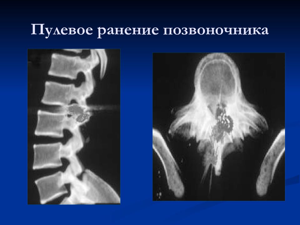 Лучевая диагностика позвоночник презентация