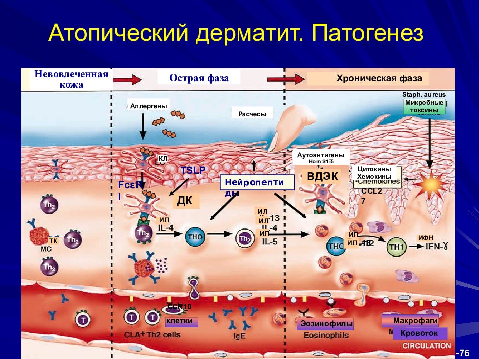 Острая кожа. Этиология атопического дерматита. Атопический дерматит этиология и патогенез. Аллергический контактный дерматит схема патогенез. Механизм развития атопического дерматита.