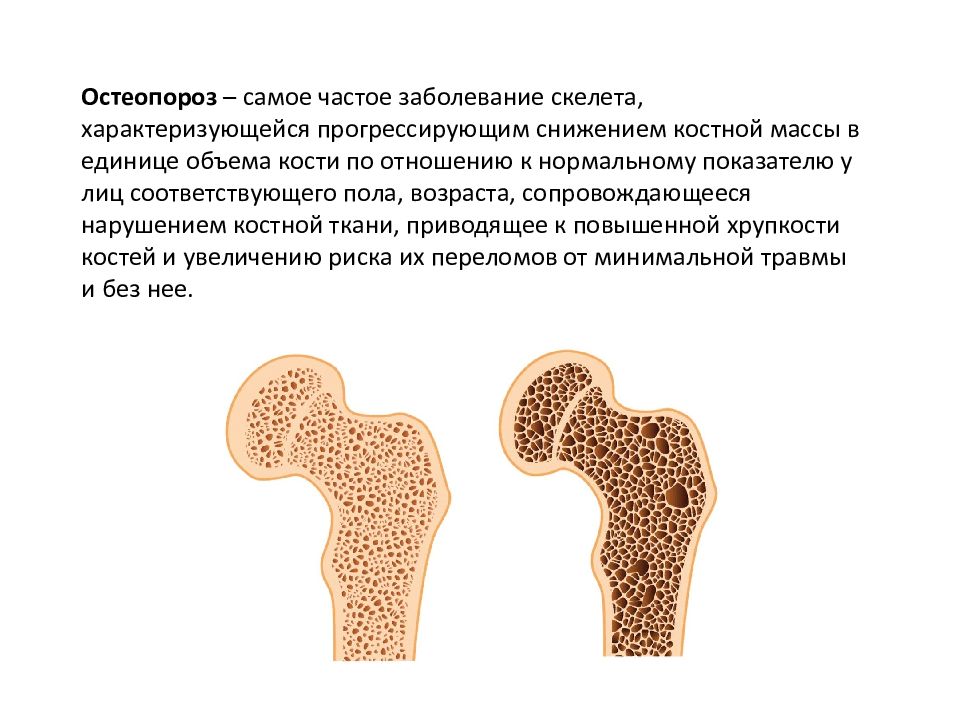 Остеопороз в стоматологии презентация