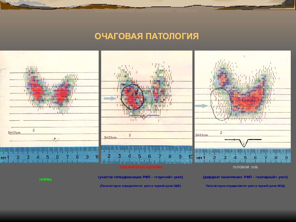 Гиперфиксация рфп что это такое. Сканограмма щитовидной железы в норме. Гиперфиксация РФП щитовидной железы. Сканограмма щитовидной железы патологии. Сегменты щитовидной железы.