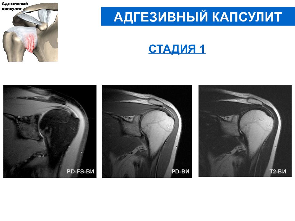 Адгезивный капсулит мрт