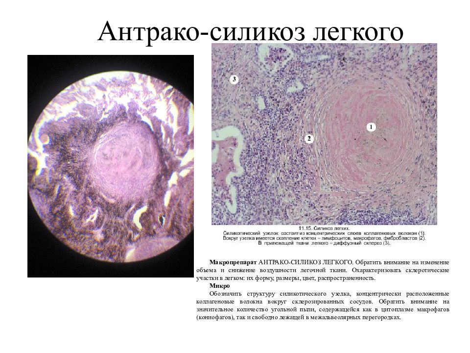 Силикоз легкого микропрепарат рисунок