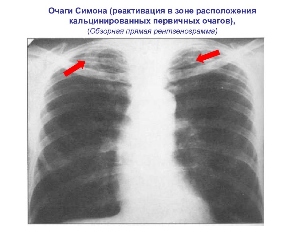 Очаги в легких. Очаги Симона на рентгенограмме. Очаги Симона при туберкулезе. Очаг Ашоффа пуля на рентгене.