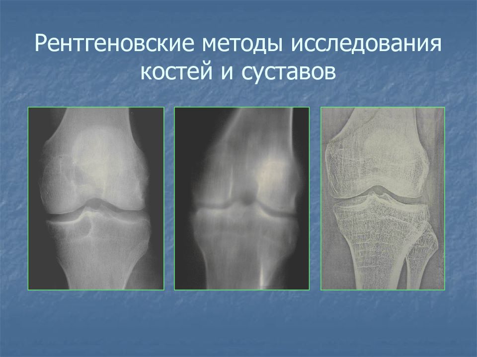 Исследование костей. Рентгенологическое исследование суставов. Рентгенологическое исследование костей. Рентгенологические методы исследования костей. Исследование костно-суставной системы.