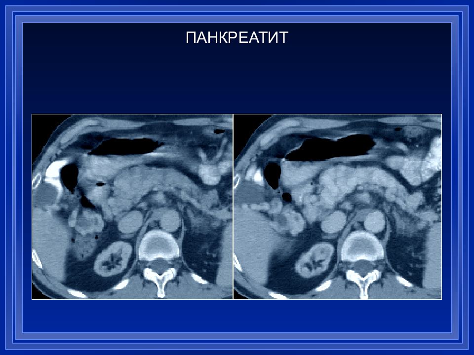 Что такое объемное образование. Дифференциальная диагностика образований печени на кт. Объемные образования печени. Кольцевидная поджелудочная железа кт. Абсцесс поджелудочной железы кт.