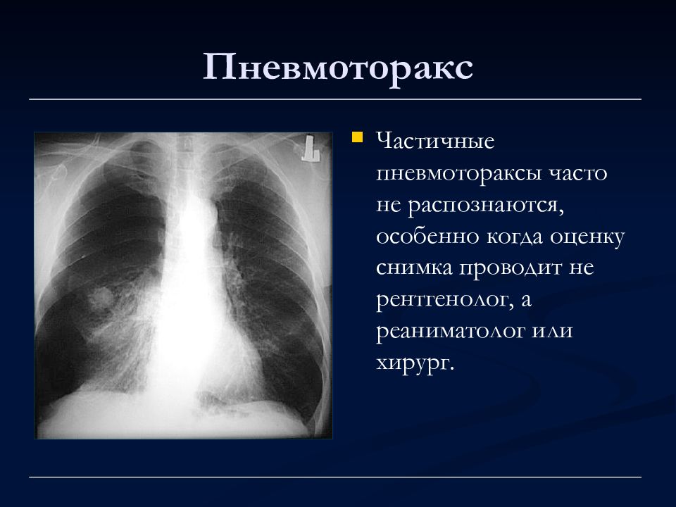 Рентген картина пневмоторакса