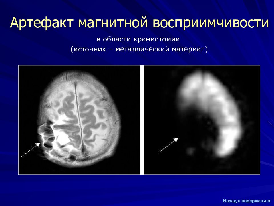 Артефакты мрт презентация