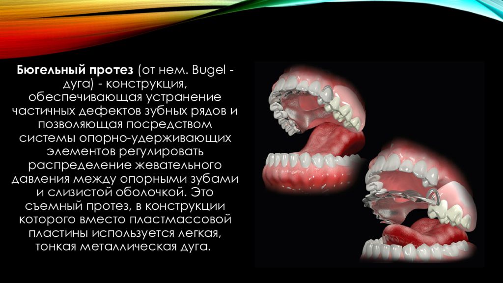 Дробители нагрузки бюгельного протеза. Бюгельные протезы презентация. Бюгельный протез презентация. Жевательное давление. Распределение жевательной нагрузки на зубы.