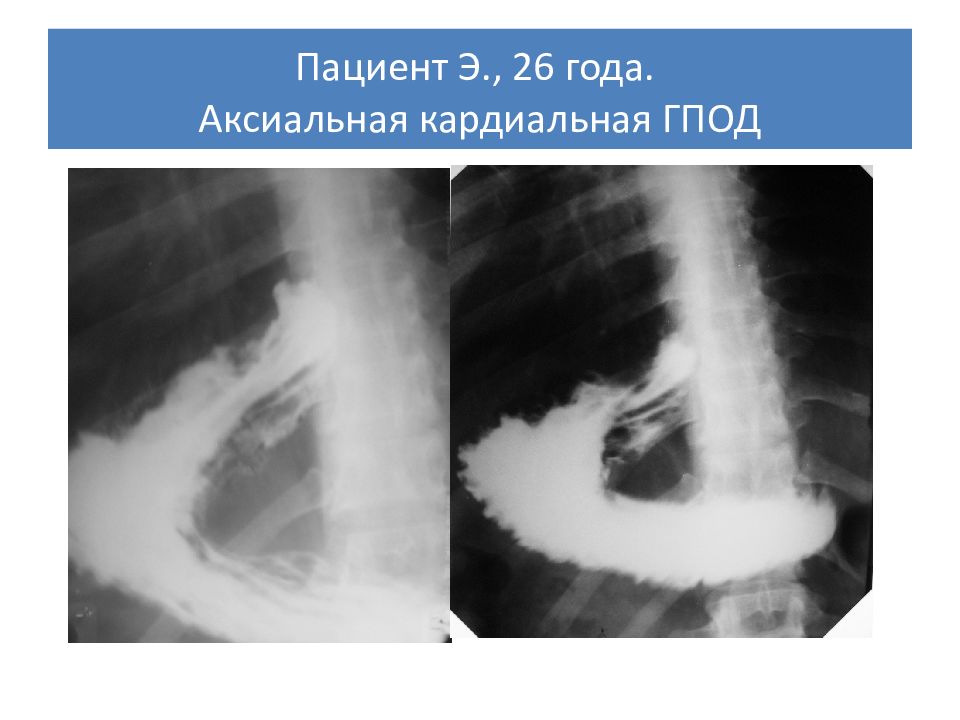 Грыжа кардиального отверстия диафрагмы. Параэзофагеальная грыжа рентген. Аксиальная грыжа пищеводного отверстия диафрагмы рентген. Кардиофундальная грыжа рентген. Параэзофагеальная грыжа пищеводного отверстия рентген.