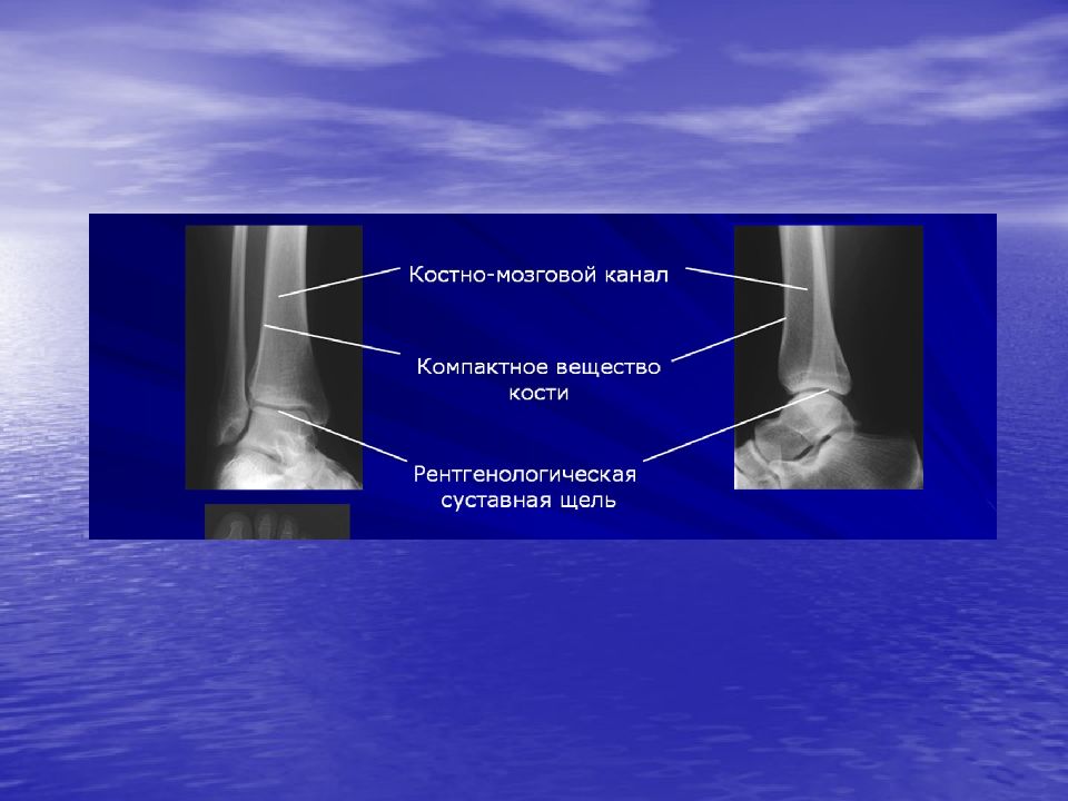 Образования трубчатых костей