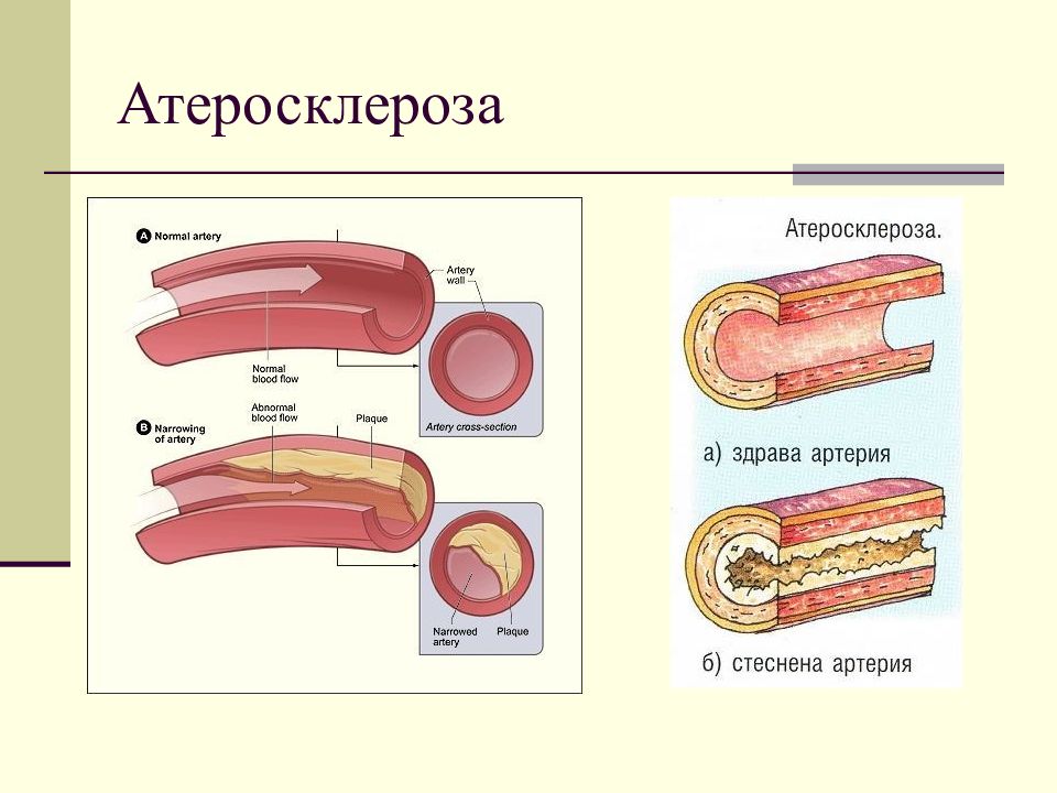 Атеросклероз признаки. Атеросклероз презентация. Атеросклероз сосудов презентация. Атеросклероз презентаци.