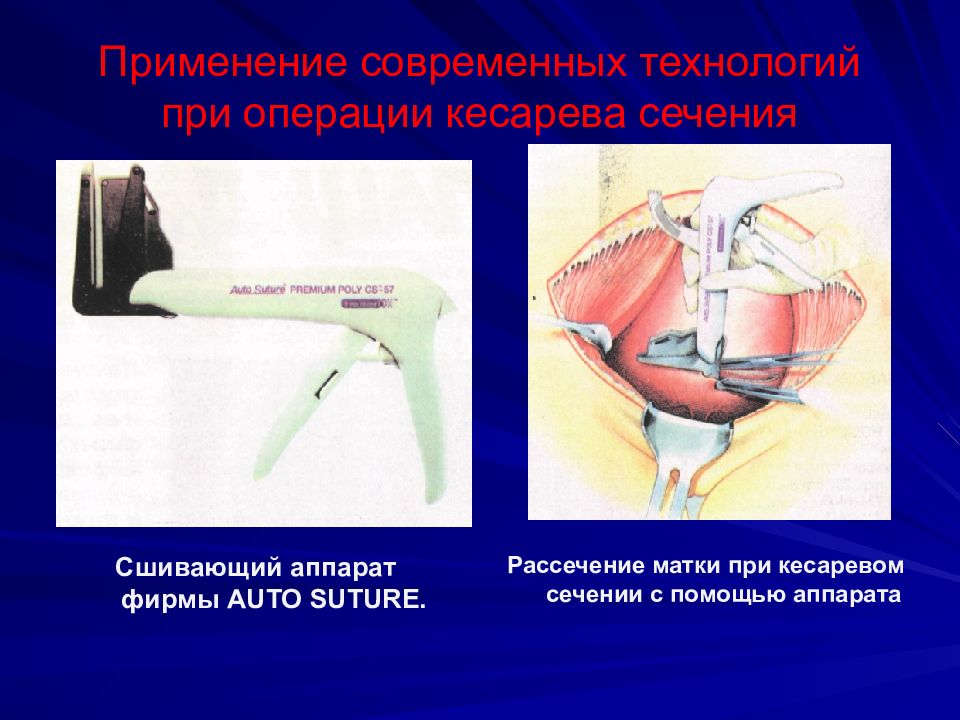 Сечение матки. Влагалищное кесарево сечение. Влагалищное кесарево сечение показания. Сшивающие аппараты в хирургии презентация. Что разрезают при кесаревом сечении.