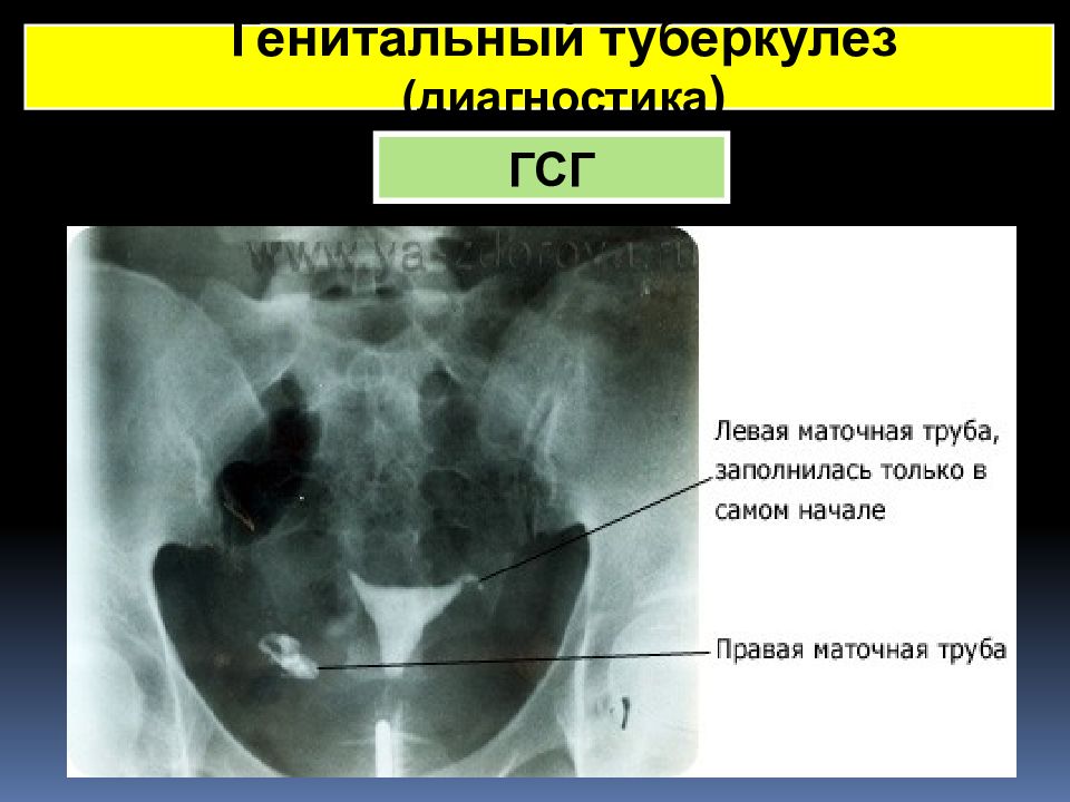 Туберкулез половых органов у женщин. Гистеросальпингография туберкулез. Туберкулез половых органов гистеросальпингография. ГСГ рентген маточных труб.