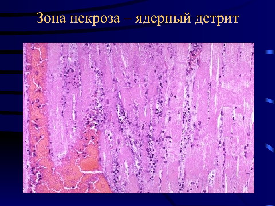 Ибс патологическая анатомия презентация