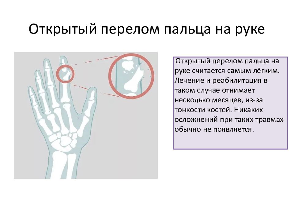 Перелом пальца кисти код по мкб 10. Открытый перелом пальцев. Наружный перелом пальца. Открытый перелом пальца руки.