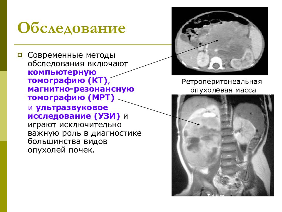 Нейробластомы у детей презентация