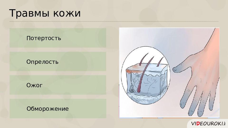 Нарушения кожных покровов и повреждения кожи 8 класс презентация