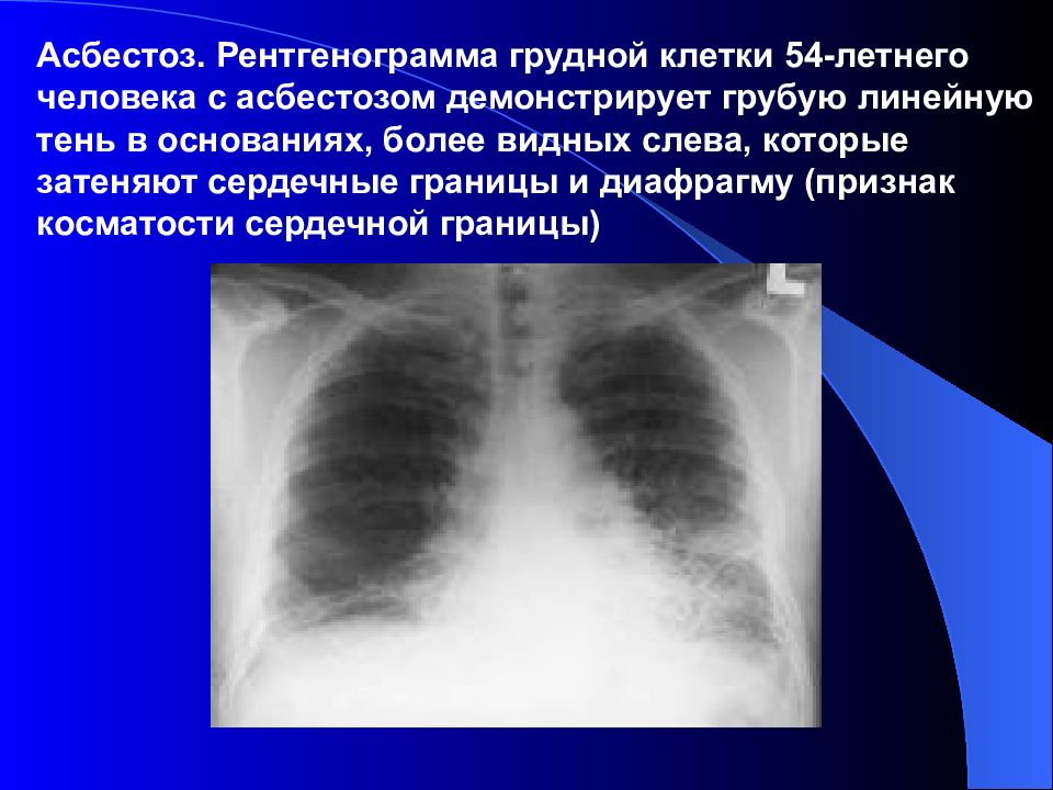 Асбестоз рентгенологическая картина