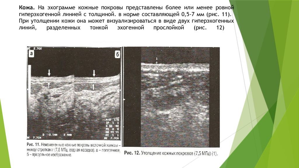 Узи молочных желез у детей. УЗИ подкожной жировой клетчатки. Отек подкожно жировой клетчатки на УЗИ. Образования подкожно-жировой клетчатки на УЗИ. Утолщение кожи молочной железы.