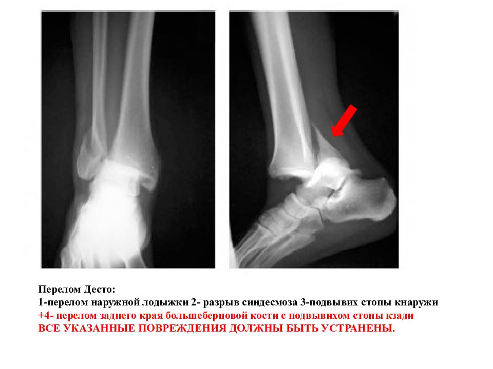 Презентация перелом костей голени