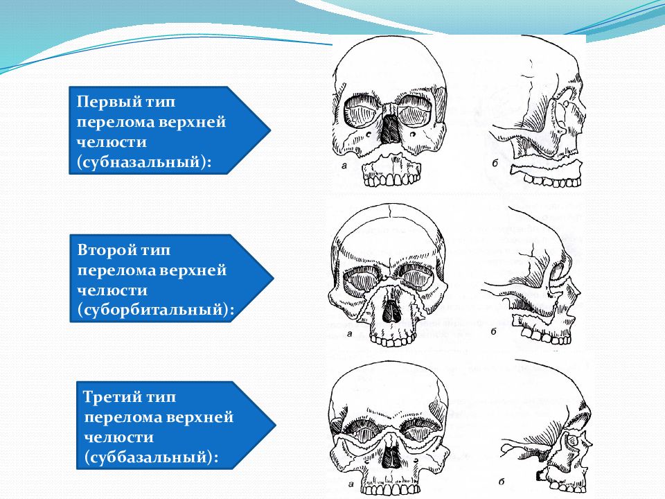 Верхний тип перелома верхней челюсти. Переломы верхней челюсти по типу Ле фор. Переломы верхней челюсти по Лефор 1. Перелом верхней челюсти по Лефор 2. Классификация перелома верхней челюсти по Ле-фор.