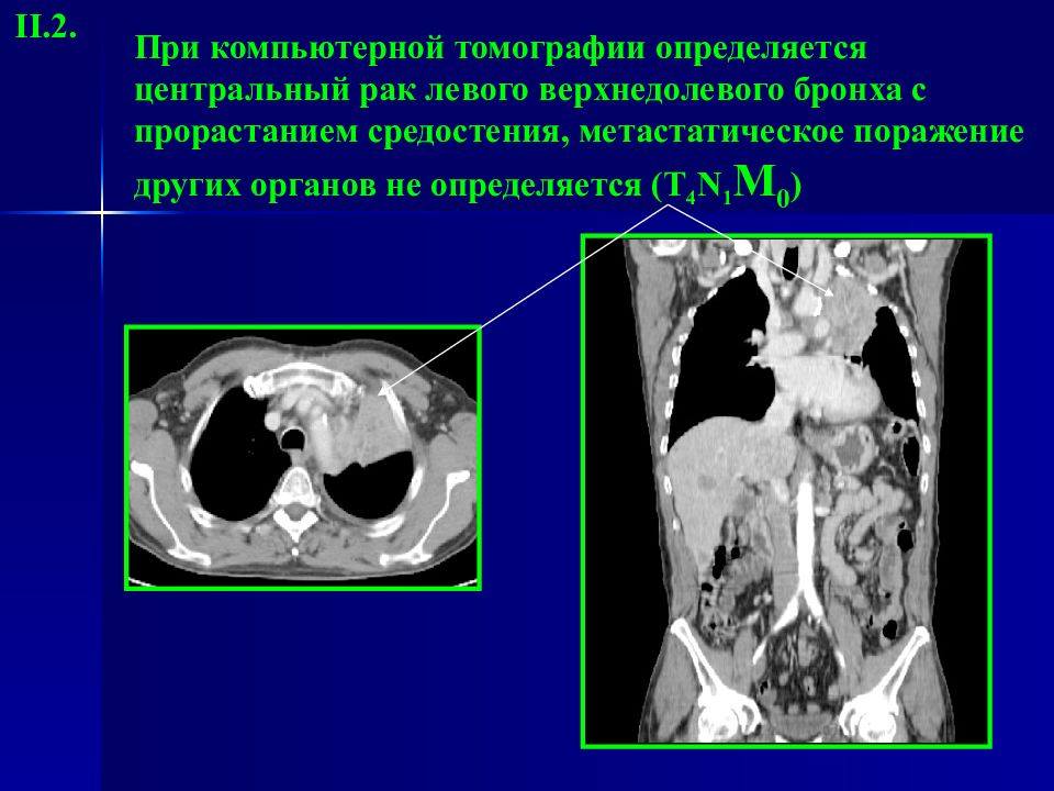 Лучевая диагностика органов средостения презентация