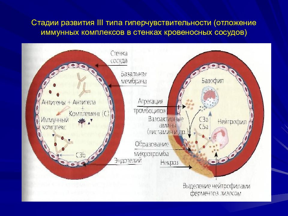 Развития 3. Отложение иммунных комплексов. Отложение иммунных комплексов в стенках кровеносных сосудов. Гиперчувствительность 3 типа стадии. Стадии развития гиперчувствительности 3 типа.