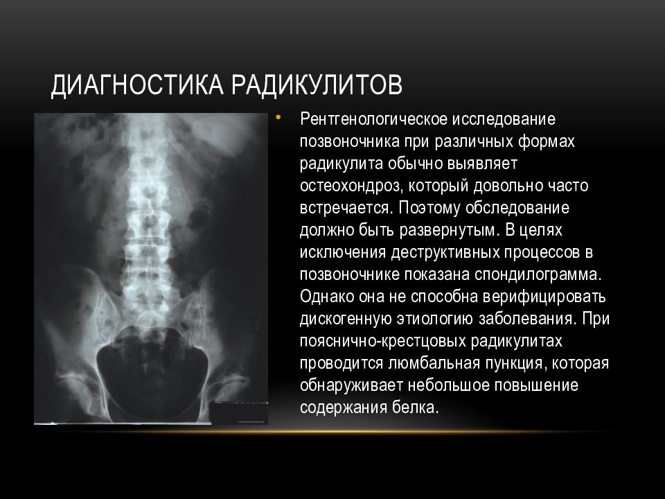 Радикулит поясничный симптомы и лечение. Пояснично-крестцовый радикулит мрт.. Методы исследования позвоночника. Радикулит презентация.