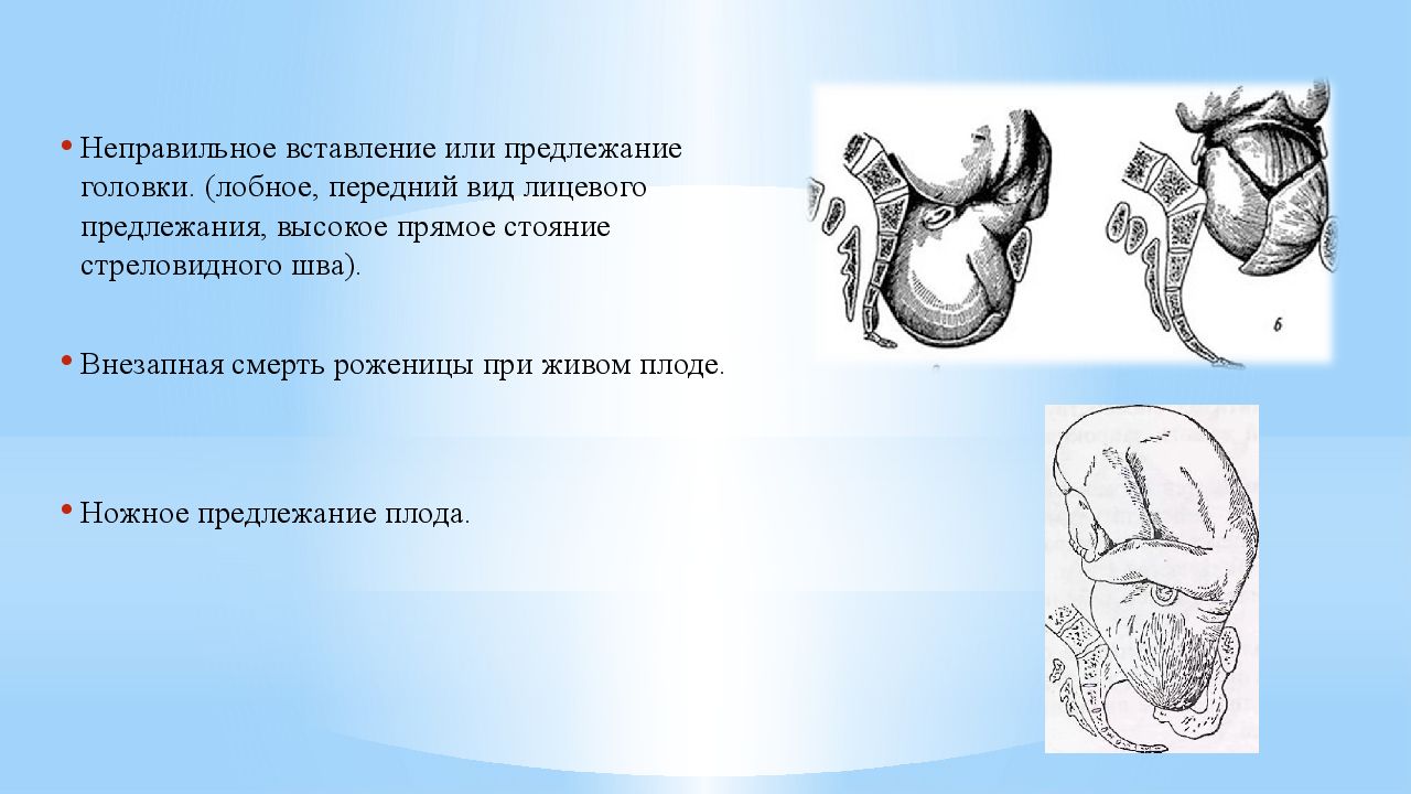 Вставление головки виды