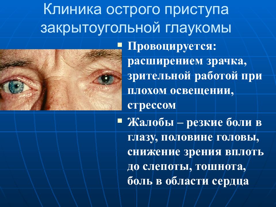 Один из супругов страдает глаукомой. Острый приступ закрытоугольной глаукомы клиника. Глаз при остром приступе глаукомы. Симптомы острого приступа закрытоугольной глаукомы. При остром приступе глаукомы зрачок.