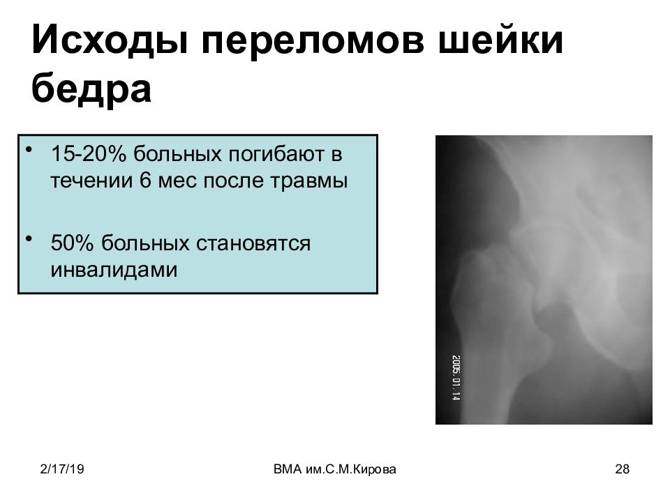 Перелом медиальной стенки глазницы степень тяжести вреда здоровью