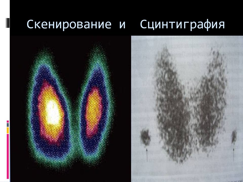 Сцинтиграфия щитовидных желез. Сцинтиграфия щитовидной железы аппарат. Гипотиреоз сцинтиграфия. Радиоизотопное сканирование щитовидной железы. Сцинтиграфия щитовидной железы холодный очаг.