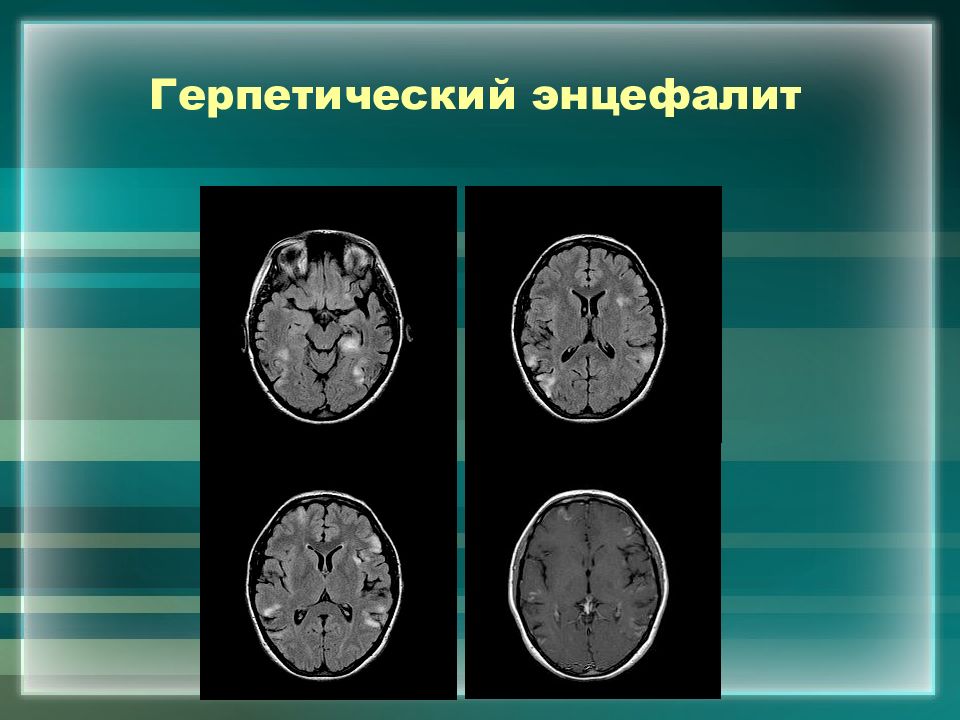 Энцефалит мрт картина