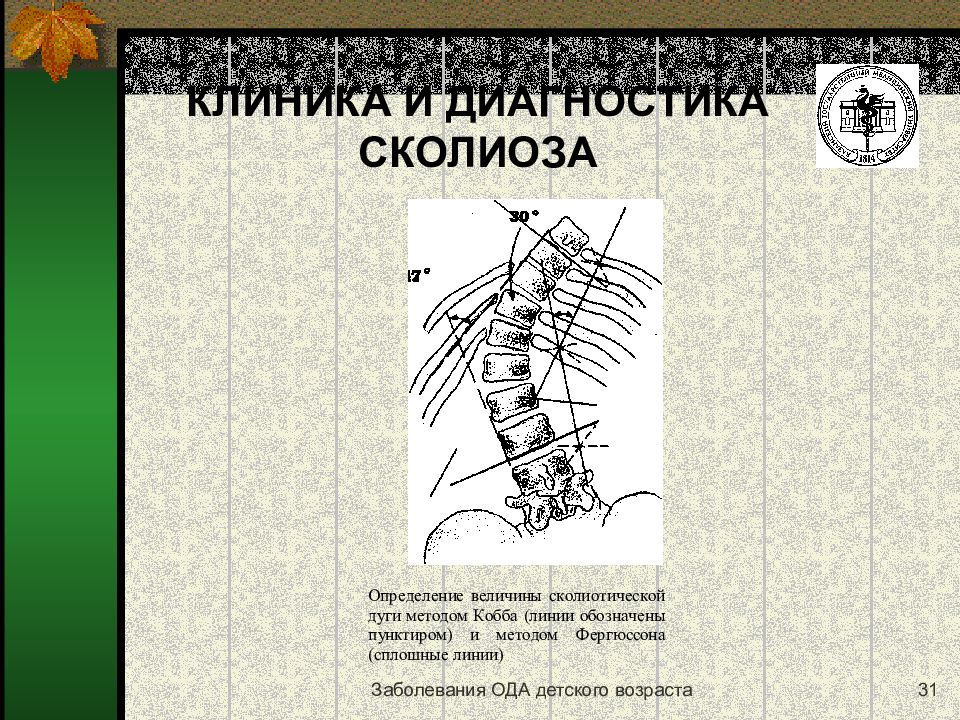 Сколиоз позвоночника презентация травматология