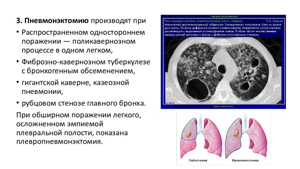 Хирургическое лечение туберкулеза презентация