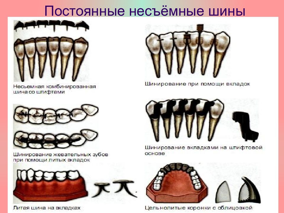 Постоянное шинирование при заболеваниях пародонта презентация