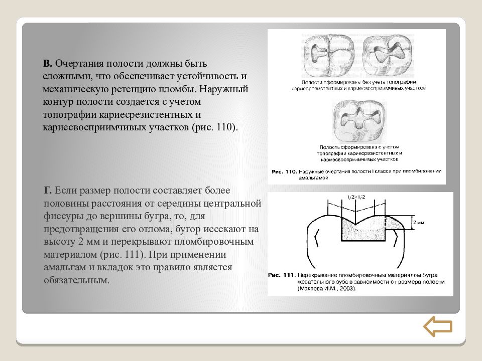 Размеры полости. Принцип ретенции и резистентности при препарировании. Кариесвосприимчивые участки зуба.. Наружные очертания полостей 1 класса. Создание зоны ретенции вкладок..