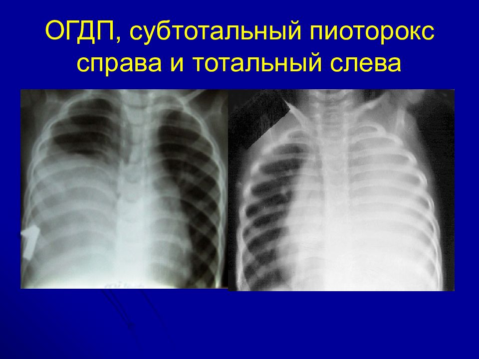 Деструктивная пневмония у детей презентация