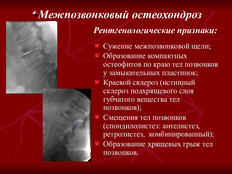 Склероз замыкательных костных пластинок. Спондилолистез поясничного отдела рентген. Рентгенодиагностика заболеваний костей и суставов. Спондилолистез степени рентген. Антелистез позвонка рентген.