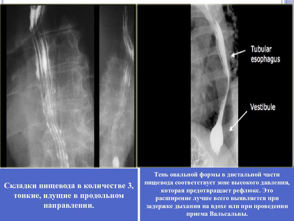 Грыжи пищеводного отверстия диафрагмы презентация по хирургии