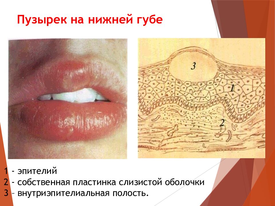 Пузырек на нижней губе