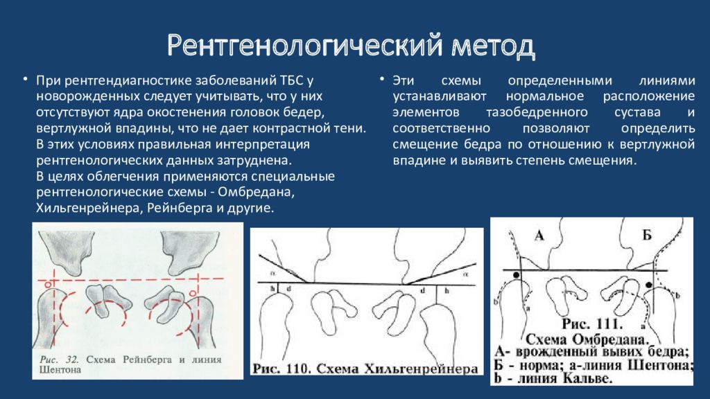 Схема врожденного вывиха бедра