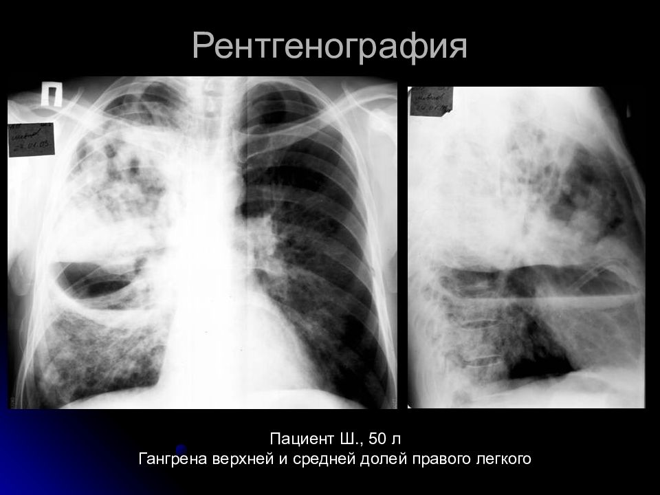 Гангрена легкого презентация