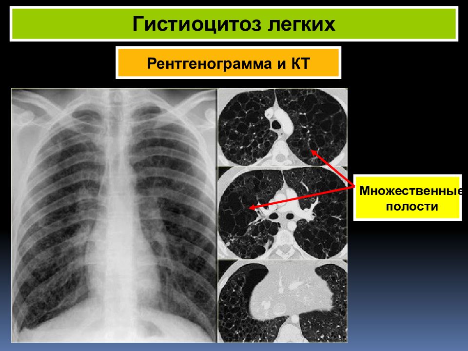 Пульмонология фтизиатрия. Гистиоцитоз х легких. Гистиоцитоз легких на кт. Гистиоцитоз легких рентген. Лангергансоклеточный гистиоцитоз легких кт.